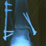 X-ray of a broken foot after ski accident